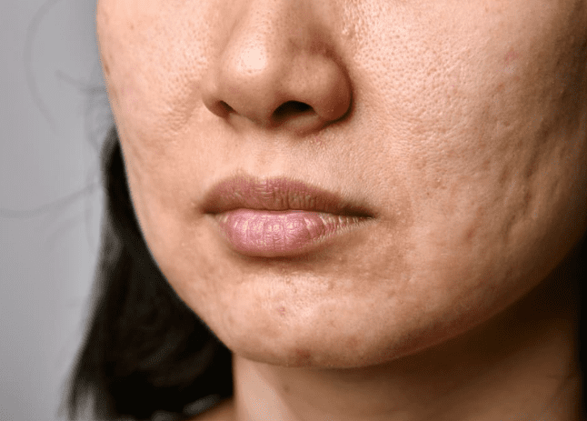 Acne scars and surgical scars Acne scars and surgical scars