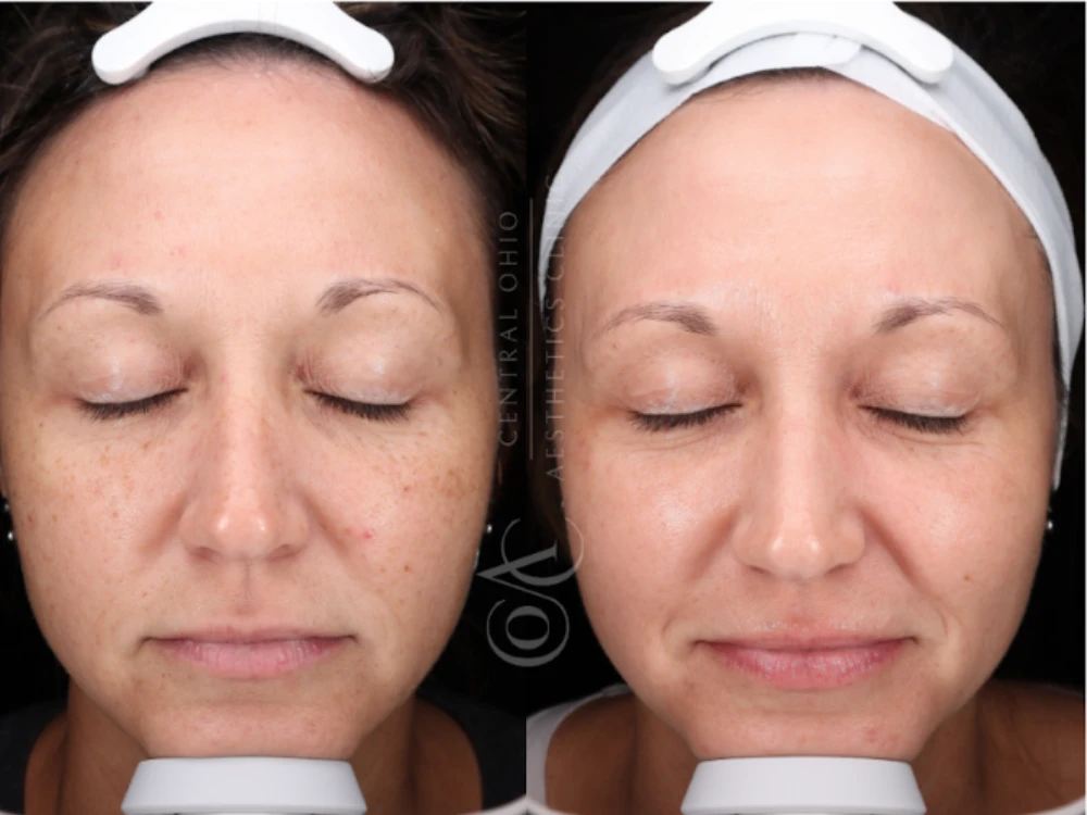 Side-by-side comparison of a woman's face before and after a skincare treatment; left shows freckles and redness, right shows smoother, more even skin tone.