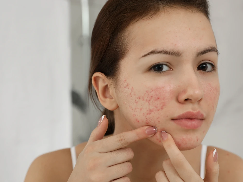 Young person with acne-prone skin looking in the mirror, gently touching facial blemishes. The expression is neutral, suggesting contemplation.