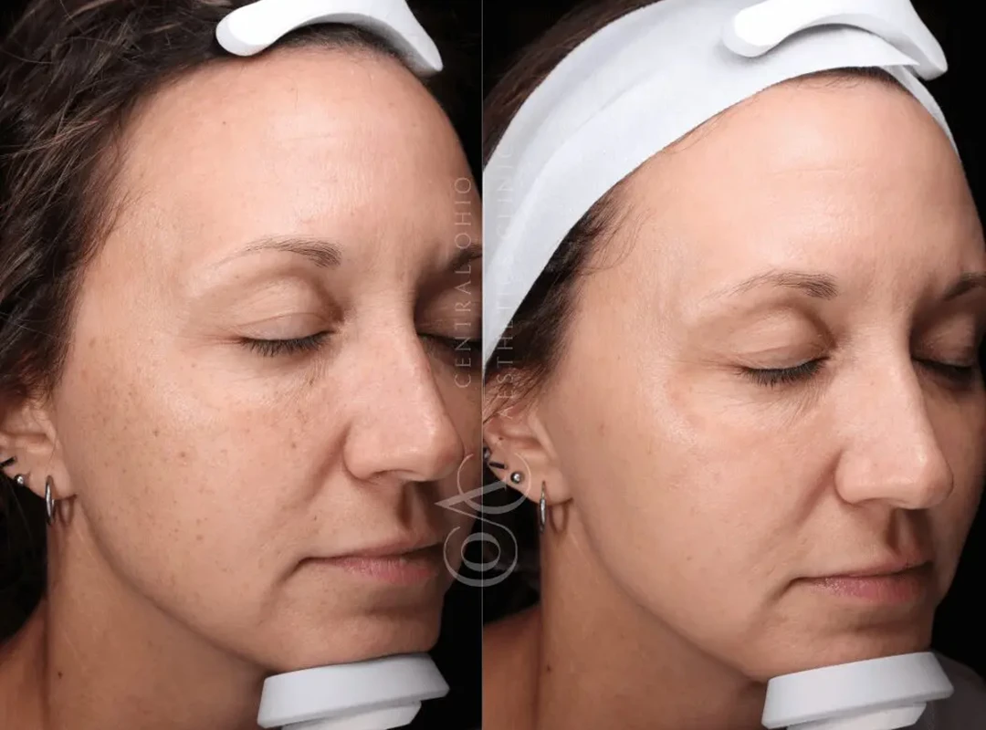 BBL Hero™ Laser Before and After Result