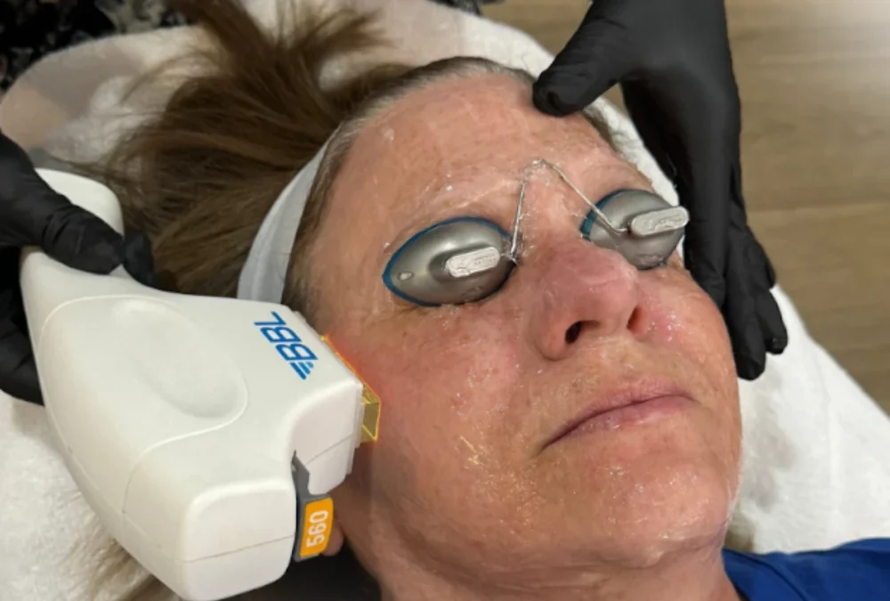 BBL Laser Aftercare in Powell, Ohio