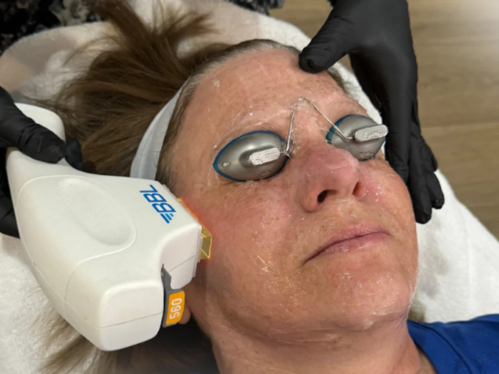 A person receives a laser skin treatment, wearing protective goggles. A technician, in black gloves, uses a BBL device on the person's cheek. The atmosphere is calm.