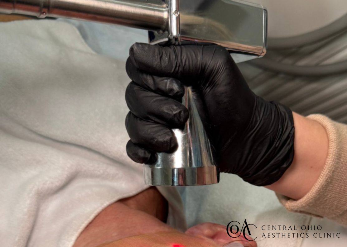 Contour Tunable Resurfacing Laser™ MicroLaserPeel™ / Contour Resurfacing Laser™