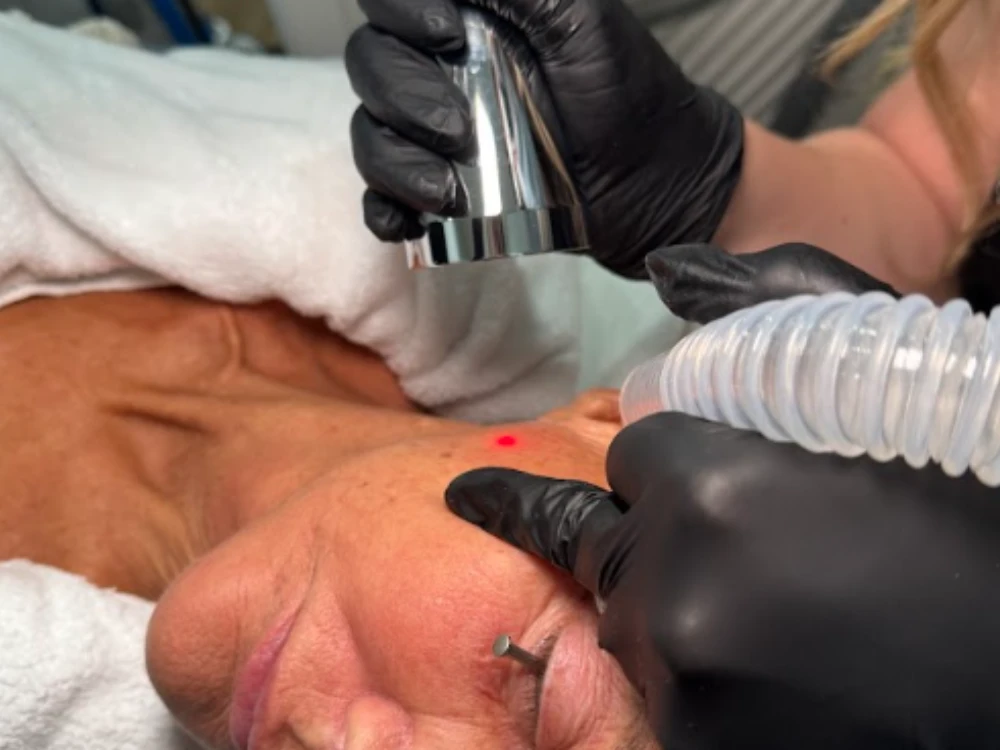 A person receives a skin treatment with a laser device on their cheek. They are covered in a white towel, while someone in black gloves holds the device, emitting a small red light.