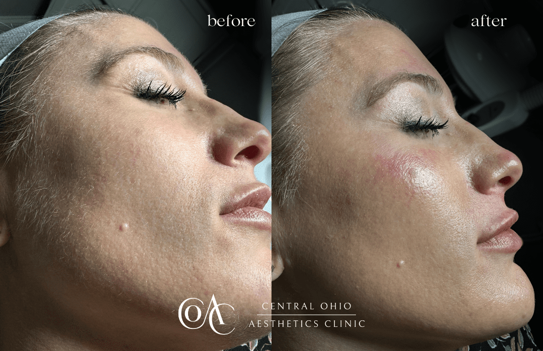 Dermaplaning Before and After Dermaplaning Before and After