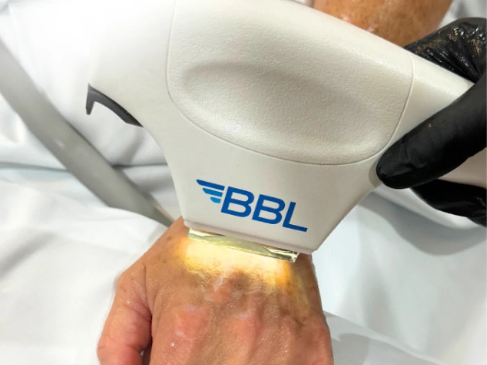 A cosmetic procedure with a BBL device on a person's hand, emitting light. The technician wears black gloves. The setting is clinical and professional.