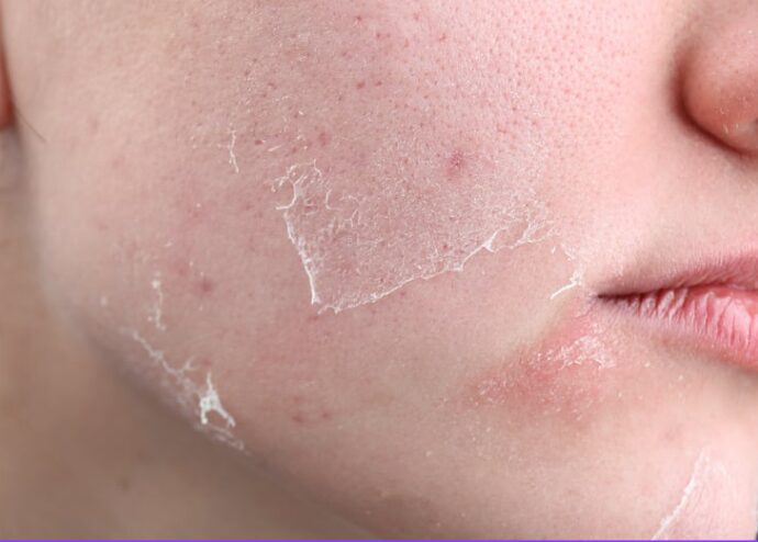 Dry Skin