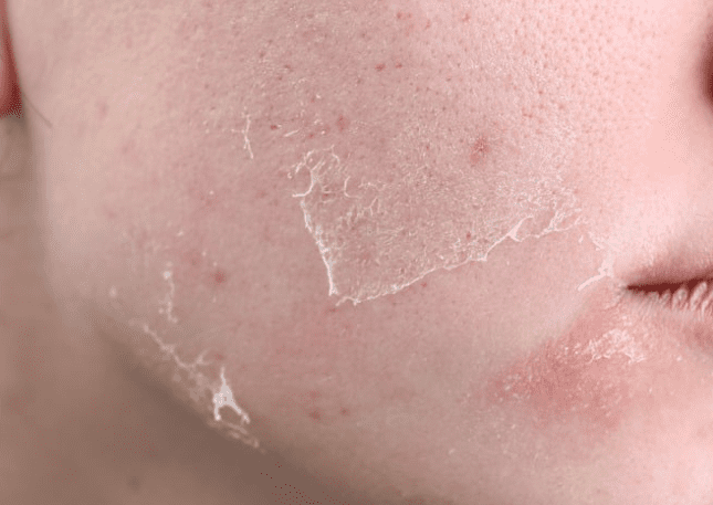 Dry or flaky skin
