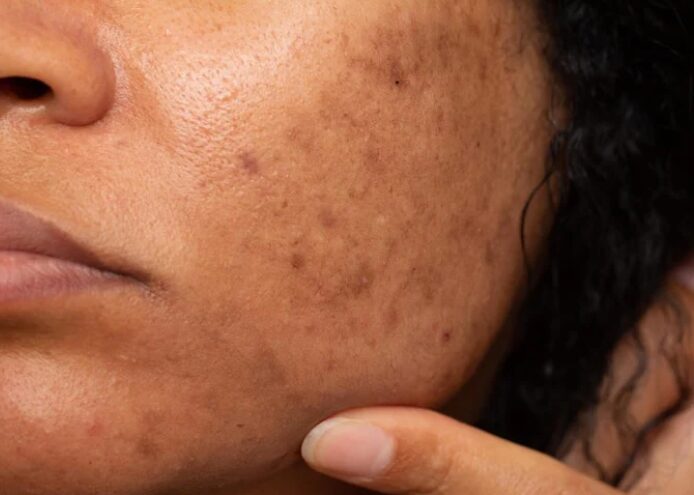Dull Skin Dull Skin
