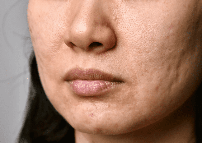 Enlarged pores