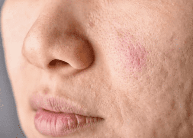 Enlarged pores