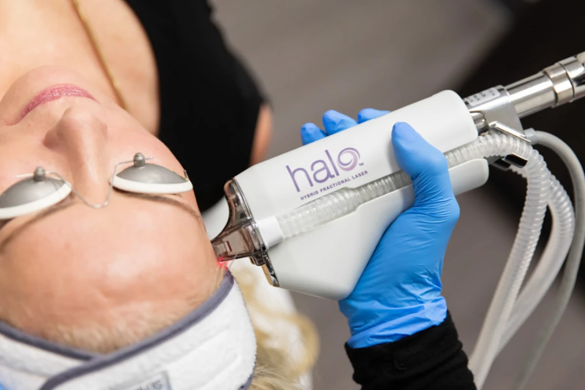 Fractional Laser Treatments (Halo™and ProFractional™)