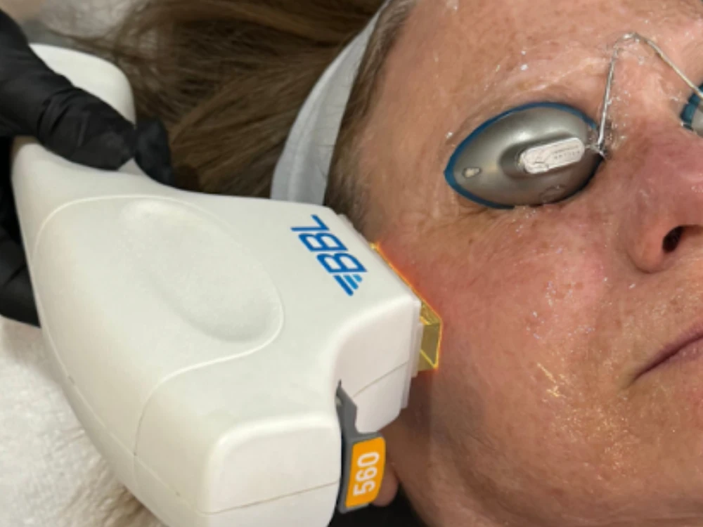 A close-up of a woman's face receiving a BBL laser treatment. She wears protective goggles and has gel on her skin. A technician holds the device.