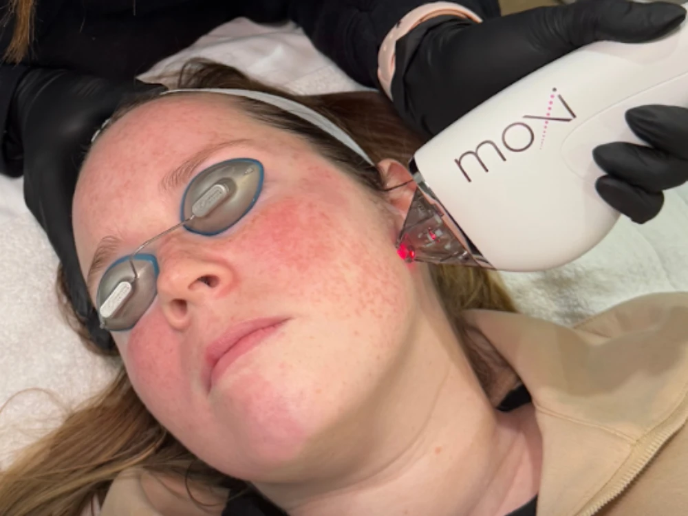 A woman with closed eyes, wearing protective goggles, undergoes a laser facial treatment. A device held by a gloved hand emits a red light on her cheek.
