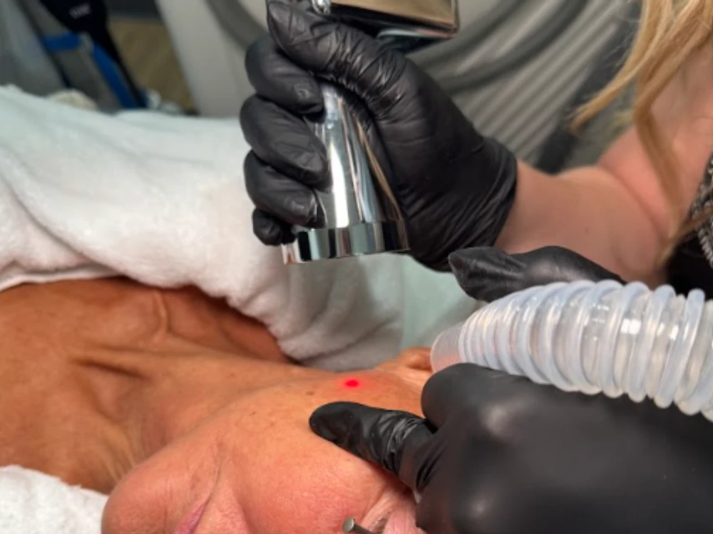 A professional wearing black gloves performs a laser treatment on a patient's forehead, marked by a red dot. The scene feels clinical and precise.