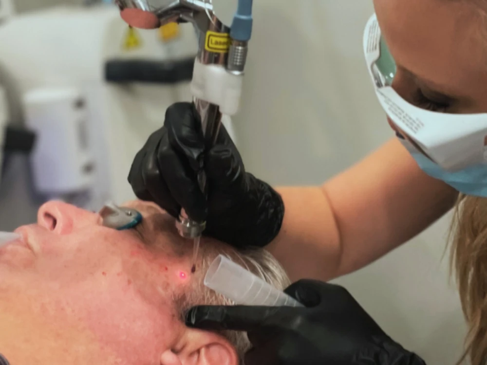 A technician wearing protective glasses and gloves performs a laser treatment on a man's face, focusing on a specific spot near his temple.