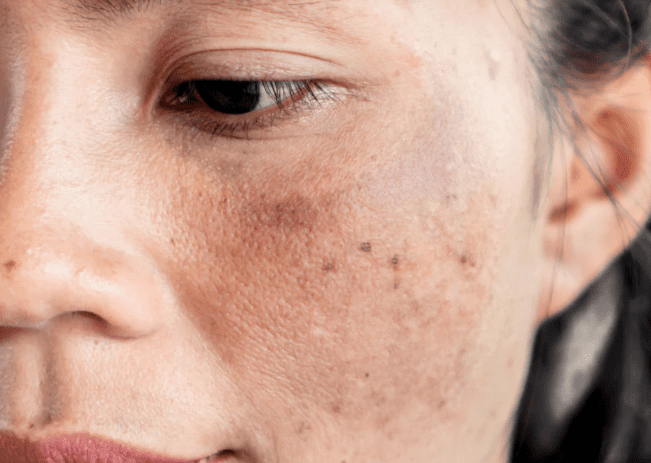Hyperpigmentation Hyperpigmentation