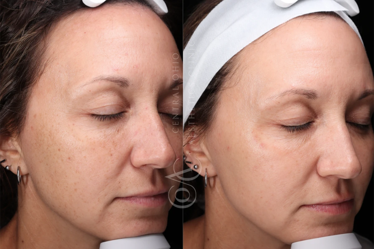 Intense Pulsed Light (IPL) or BroadBand Light (BBL HERO)™ 