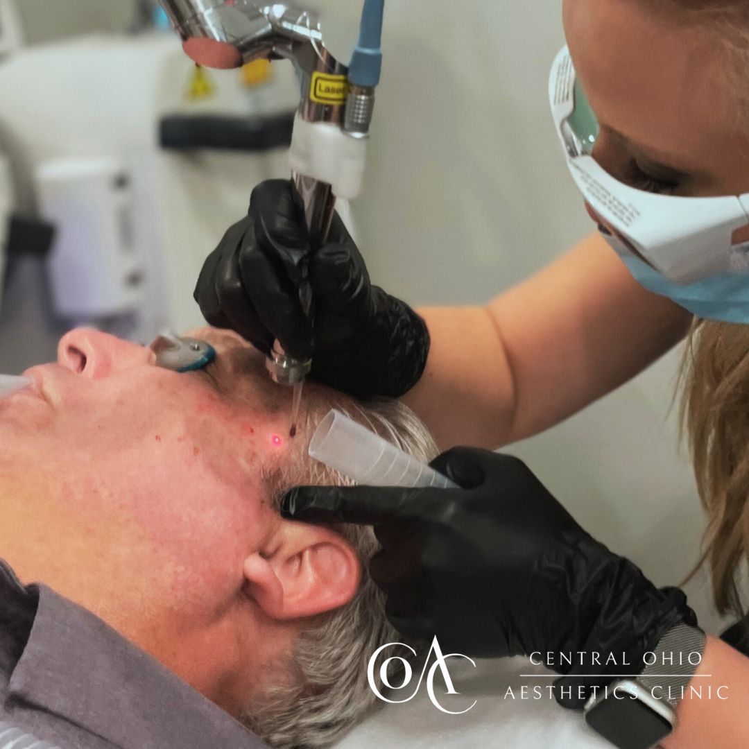 Laser Skin Resurfacing Process Laser Skin Resurfacing Process