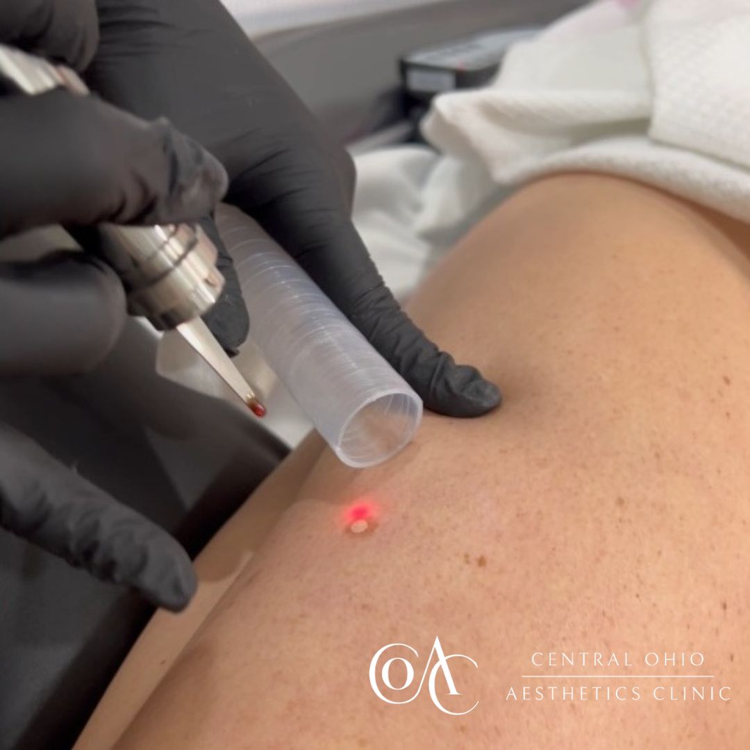 Laser Skin Resurfacing Process Leg Laser Skin Resurfacing Process Leg