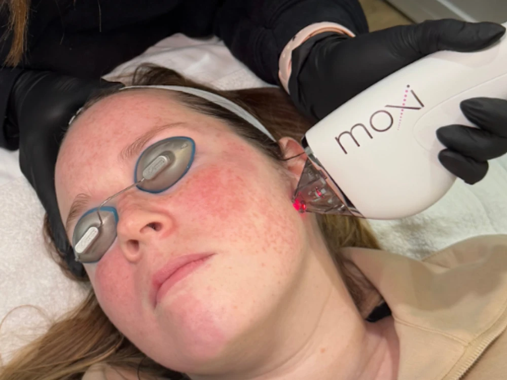 A person receives a facial laser treatment. They wear protective goggles, and a practitioner in black gloves uses a white laser device on their cheek.