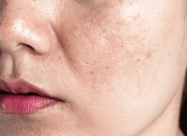 Melasma Melasma