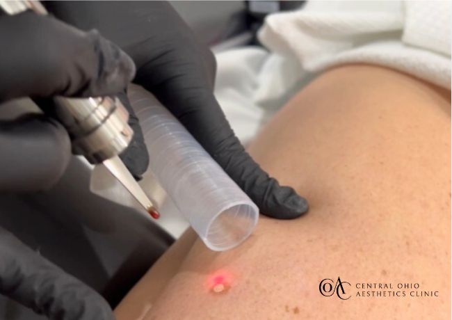 MicroLaserPeel&trade; Spot Treatment