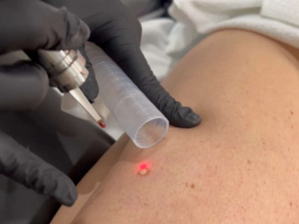 A gloved hand operates a laser tool on skin, targeting a mole with red light. The setting appears clinical, suggesting a medical procedure.
