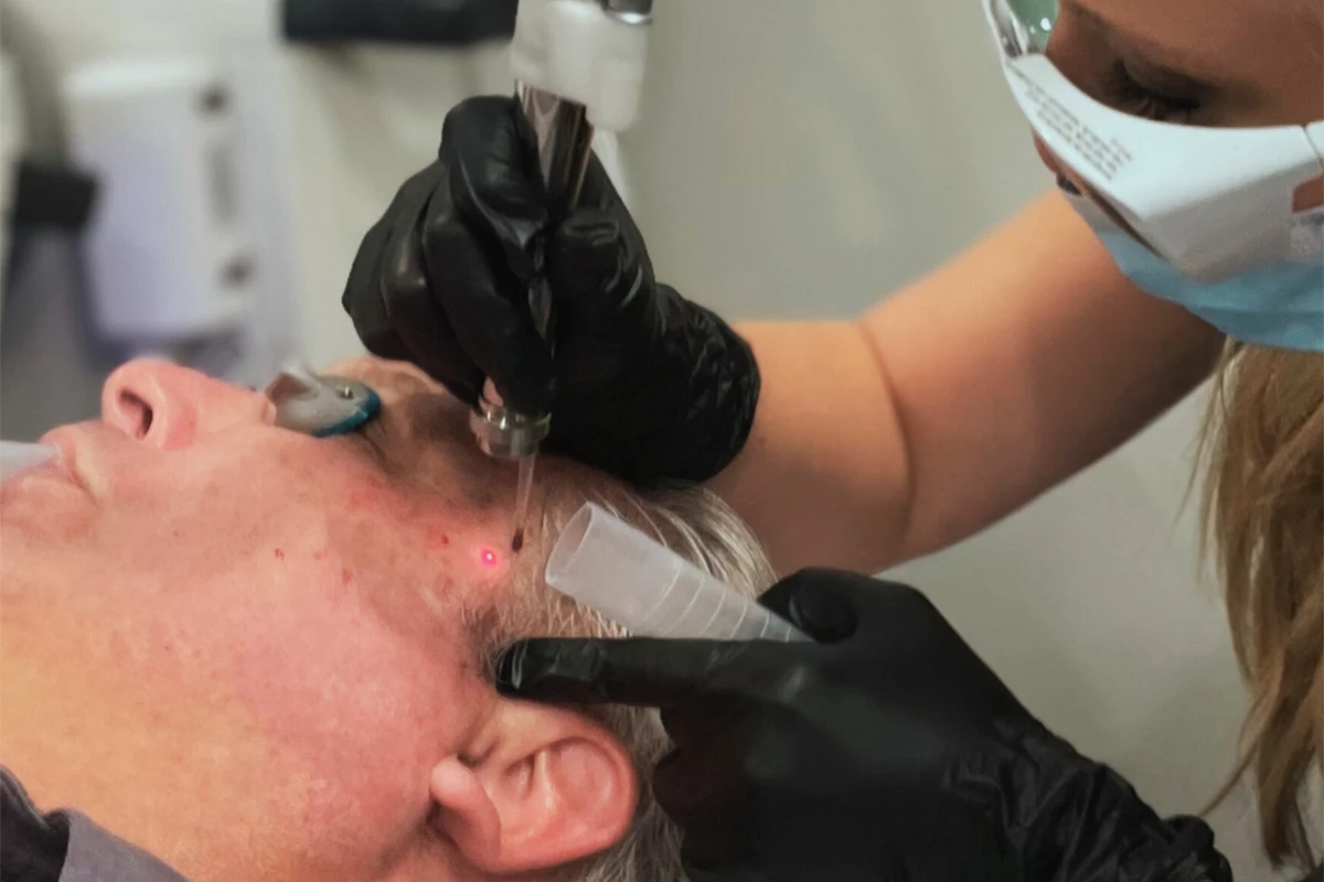 MicroLaserPeel™ or Contour Tunable Resurfacing Laser™ (TRL)