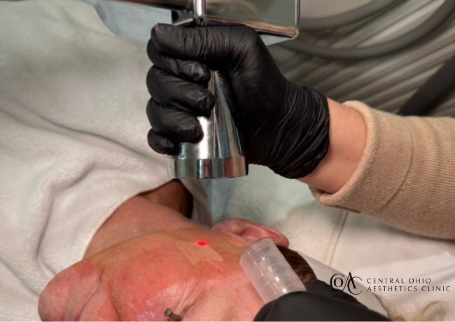 Microlaser Peel