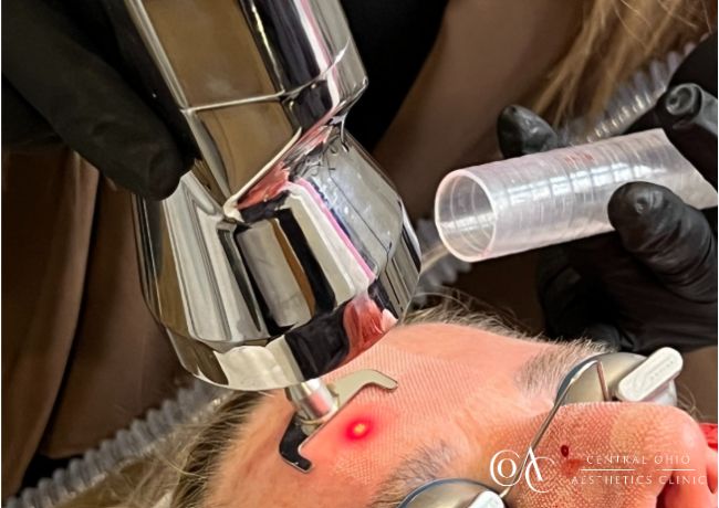 Microlaser Peel (2)