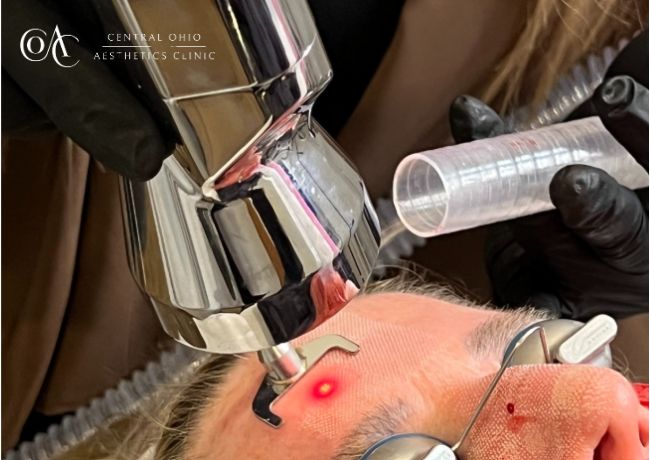 Microlaser Peel (2)