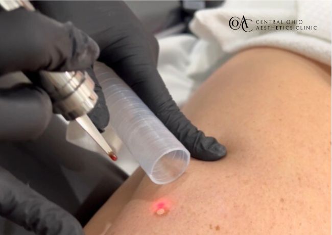 Microlaser Peel (3)