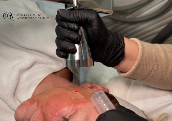 Microlaser Peel