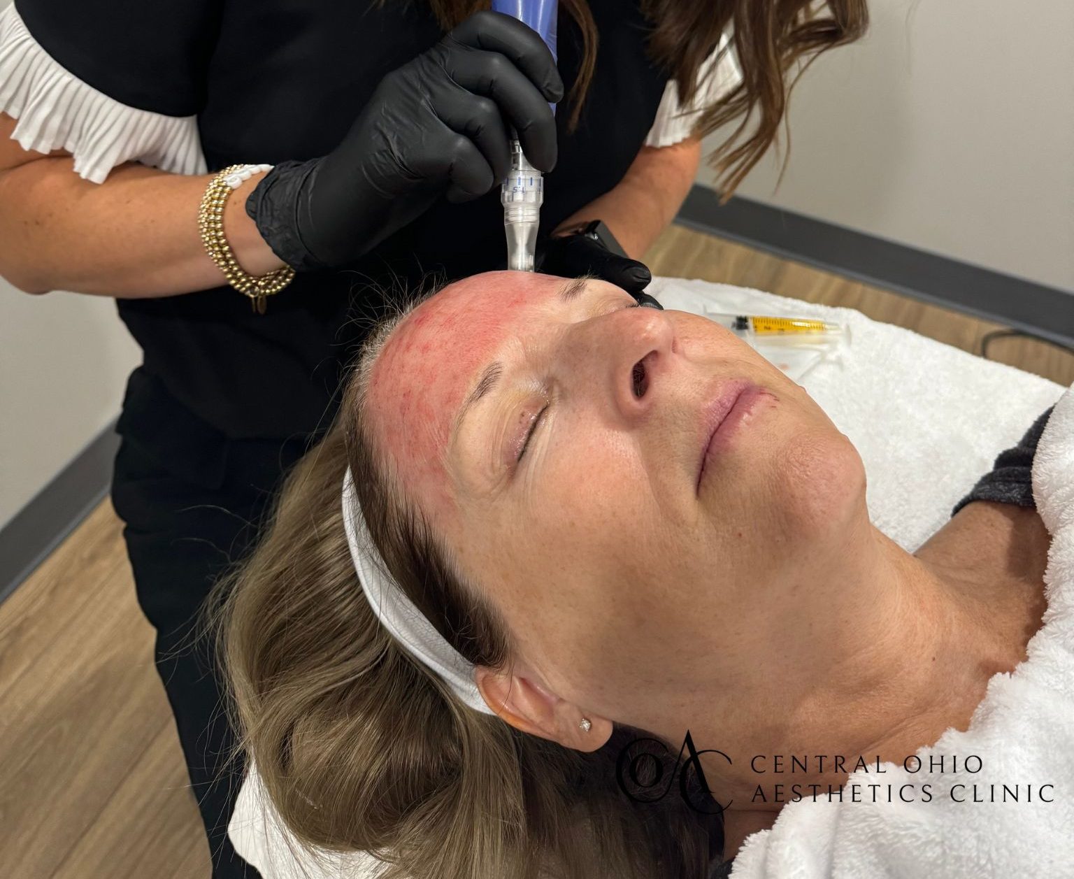 Microneedling What Is Microneedling