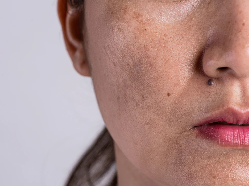 Close-up of a woman's face showing acne scars and skin blemishes. Her lips are slightly parted, wearing pink lipstick, on a neutral background.