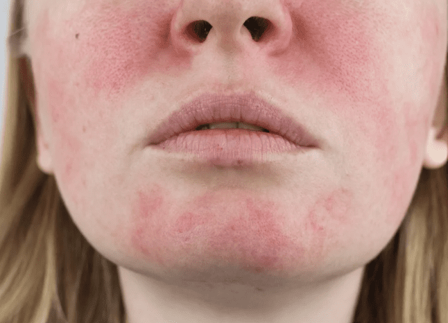 Redness and sensitivity