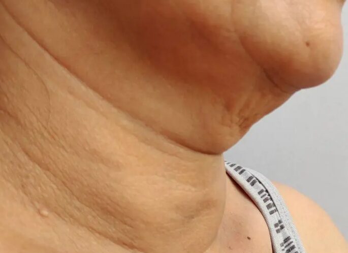 Sagging Skin on Neck Sagging Skin on Neck