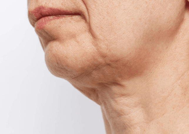 Skin laxity