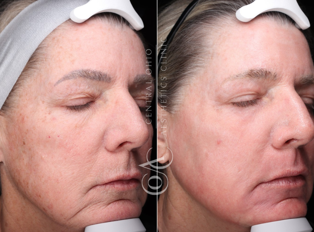 Skin Resurfacing