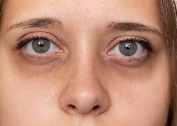 Under-Eye Darkness and Puffiness