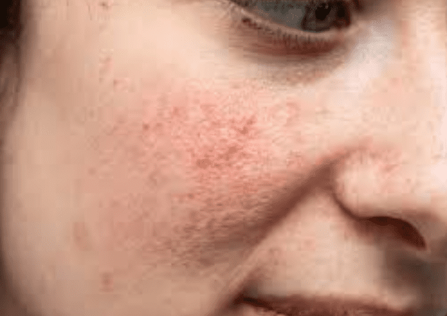 Uneven skin texture Uneven skin texture