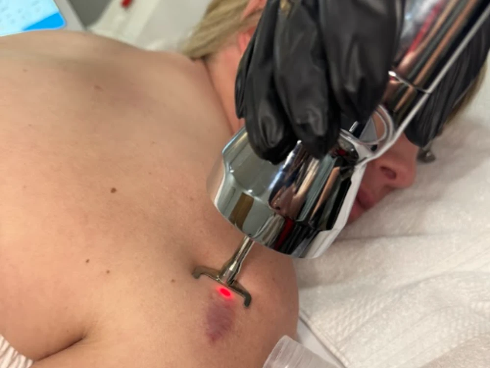 A person receives a laser treatment on the shoulder, targeting a bruise. A hand in a black glove holds the device, emitting a red light. The scene is clinical and focused.