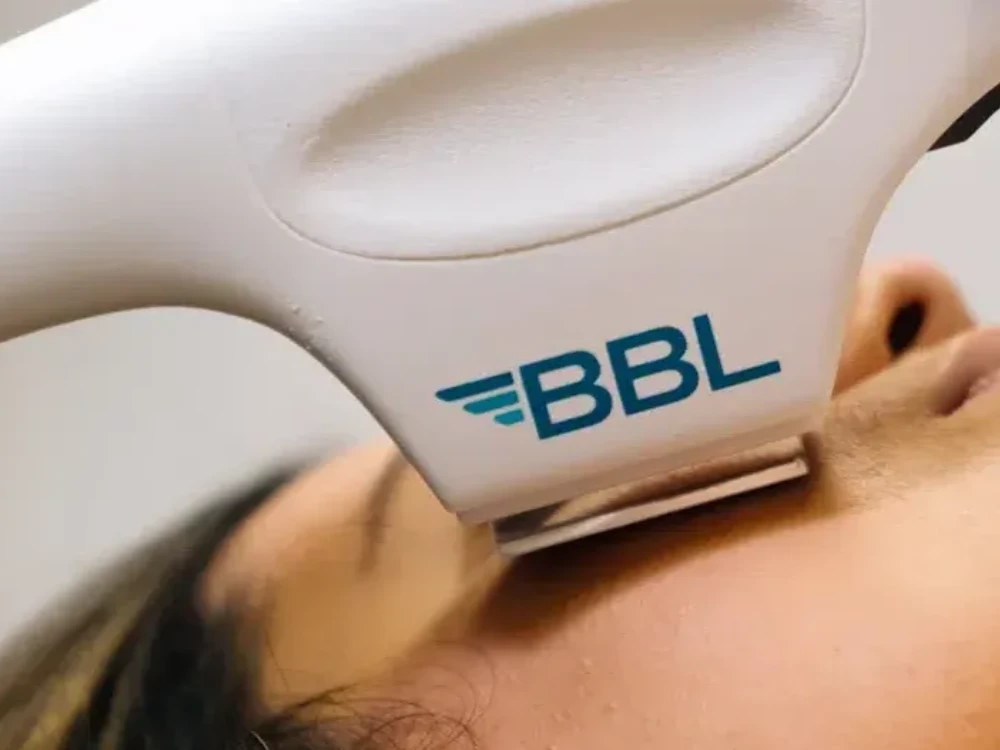 Close-up of a BBL laser device applying treatment to a person's face. The device is white with blue lettering, conveying a clinical and professional tone.