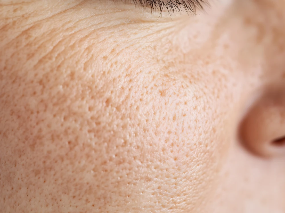 Close-up image of a person's cheek showing detailed skin texture with visible pores and fine lines. The skin tone is light and natural.
