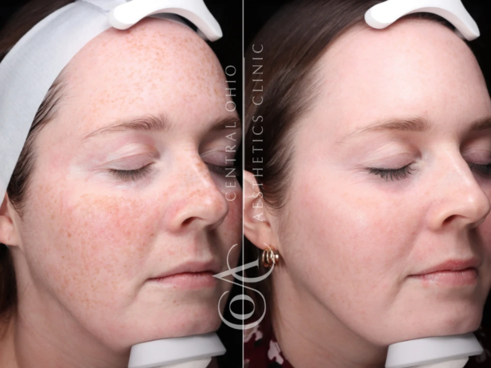 Side-by-side comparison of a woman's face before and after a skin treatment. Left shows freckles and redness; right shows smoother, clearer skin.
