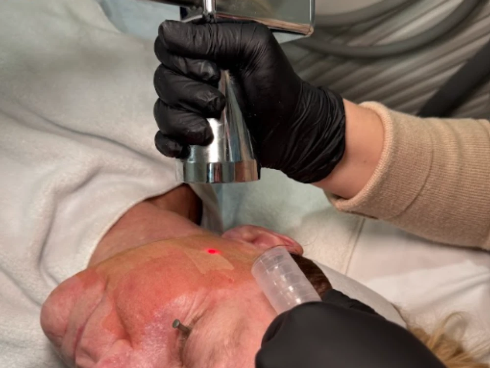Person receiving laser skin treatment; face partially covered with a cloth, laser device held by a gloved hand emits red light, creating a focused atmosphere.