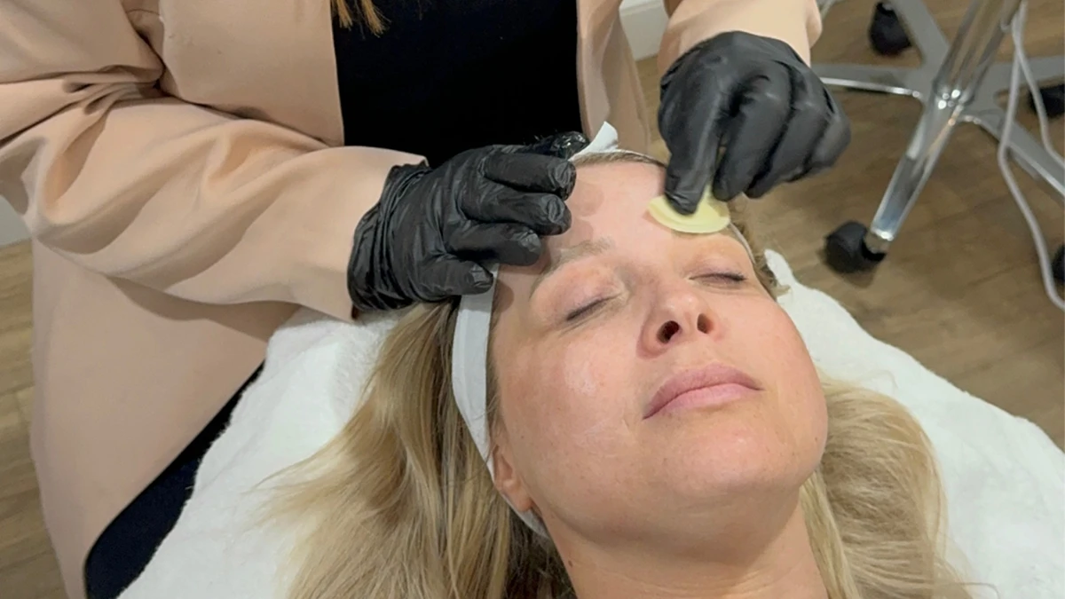 How Many Chemical Peels Are Usually Needed?