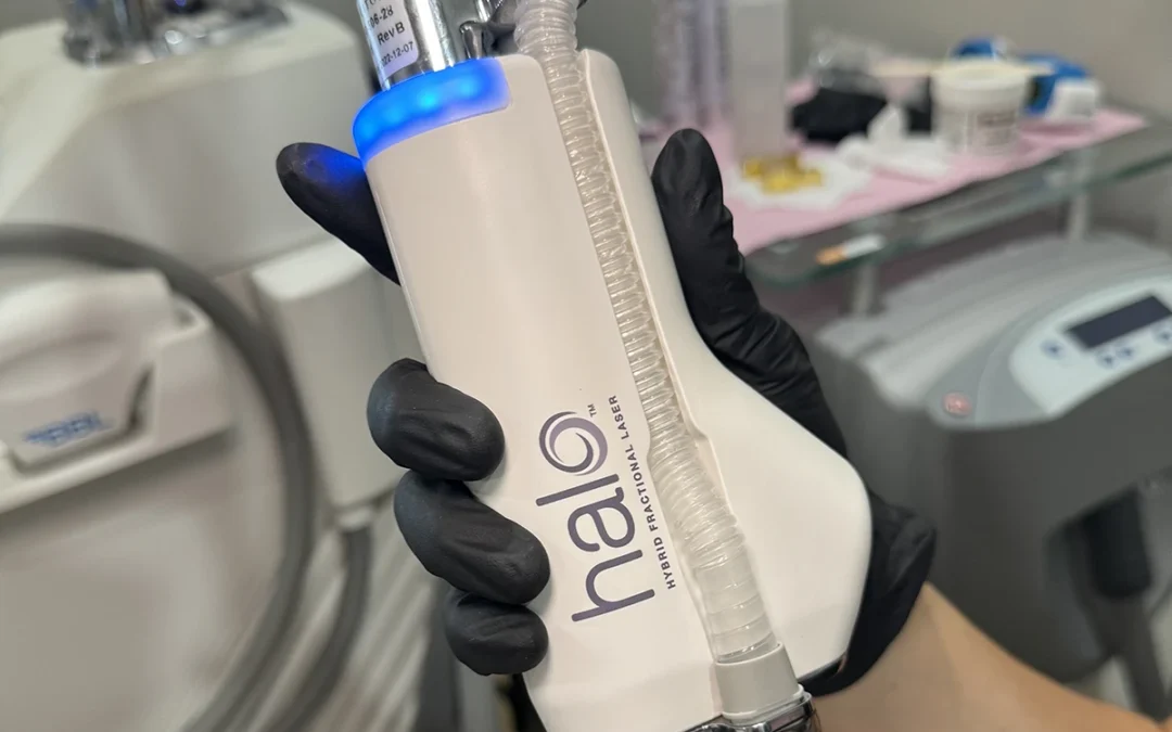 Your Guide to Laser Treatment for Sun Damage