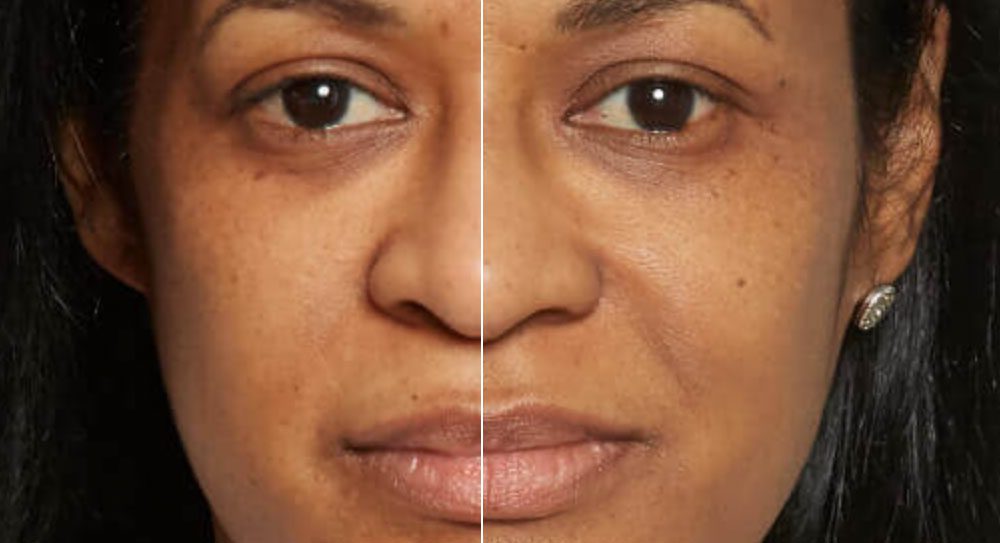 Dermaplane Treatment Delaware